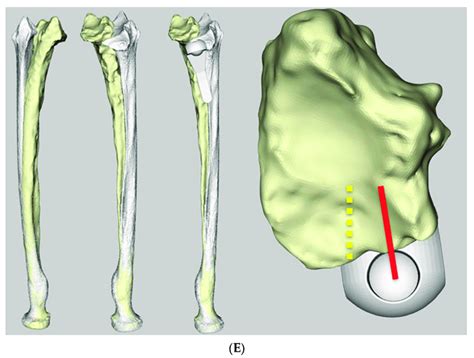 A Lateral And Anteroposterior X Rays Of Case 1 Before Implantation Download Scientific