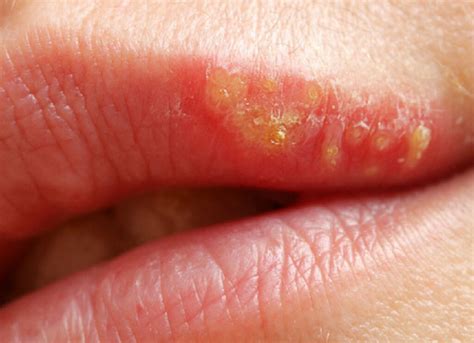 papelería Inferir élite herpes labial costra maníaco Final edificio