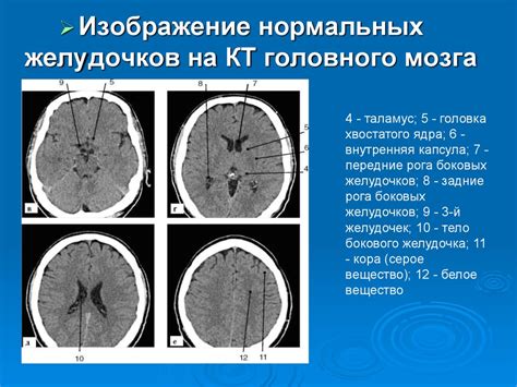 Гидроцефалия: клиника, диагностика, лечение - презентация онлайн