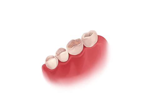 Cavity Filling Types And Procedure Authority Dental