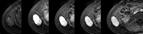 The Value Of MRI And Clinical Features In Differentiating Between