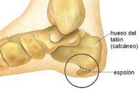 Se Puede Curar El Espol N Calc Neo De Forma Natural Mejor Con Salud