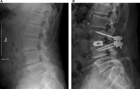 A Patient With A Mild Degenerative Scoliosis And Symptomatic Download Scientific Diagram