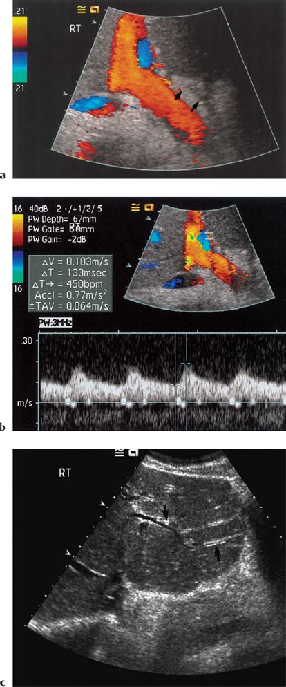 Ultrasound Follow Up Of Liver Transplantation Radiology Key