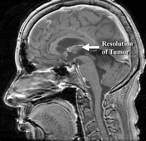 STEREOTACTIC RADIOSURGERY – Metastatic Brain Tumors Treatment Center of ...