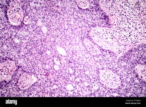 Photomicrograph Of Basal Cell Carcinoma Displaying Malignant Basal Cells Typical Of The Most