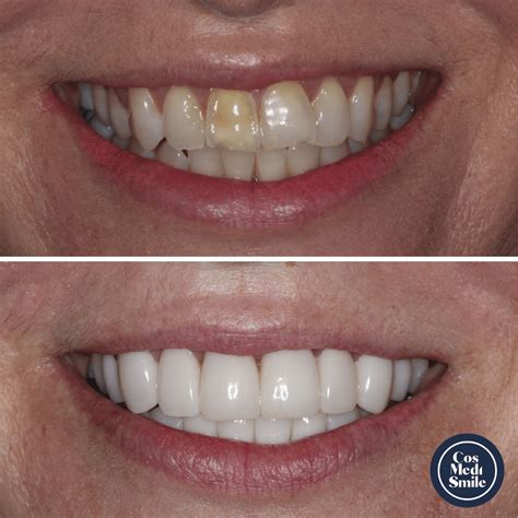 Smile Makeover Cosmedismile