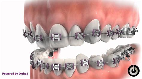 Removable Bite Plate With Braces Youtube