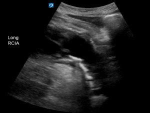 Discovering The Aorta Through Ultrasound Critical Care Sonography