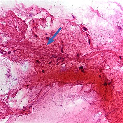 PASF-fs stain: pink staining fungus is contrasted well by the green... | Download Scientific Diagram