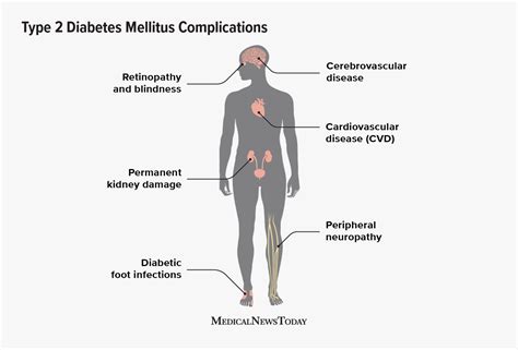 Potential Complications Of Type 2 Diabetes