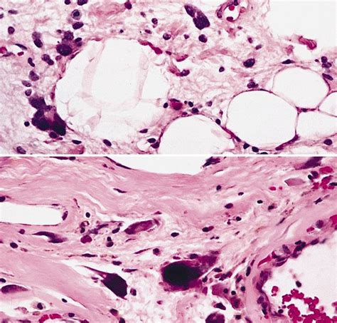 Pathology Outlines Atypical Lipomatous Tumor Well Differentiated