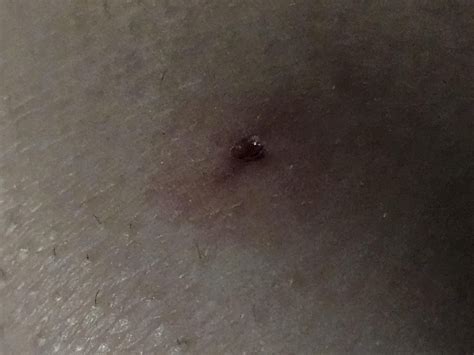 Felt something bite in my pants, been seeing a ton of brown recluse