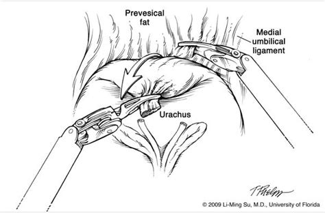 Robotic Nerve Sparing Radical Prostatectomy Department Of Urology