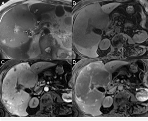 Solitary Hepatic Lymphoma A The Large Mass Filling The Central Liver