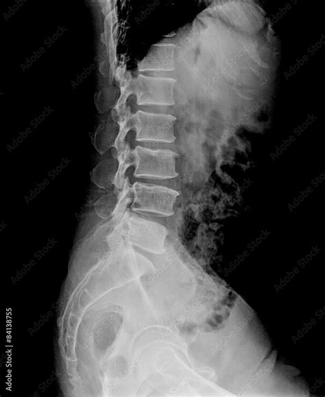 Lateral Lumbar Spine Xray