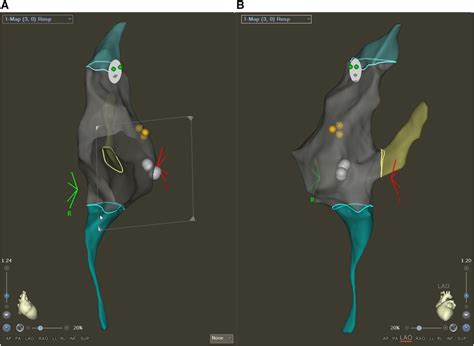 Electroanatomical Map Created With The Carto3 System In A Patient With