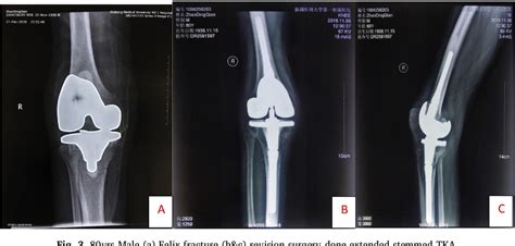 Figure 1 From Management Of Periprosthetic Fractures Of Knee Arthroplasty With Revision Surgery