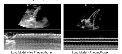 Figure From M Mode Ultrasound For The Detection Of Pneumothorax