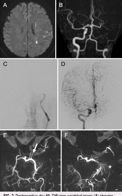 Figure From Paraclinoid Internal Carotid Artery Aneurysm With Delayed