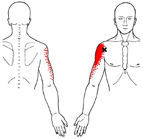 Deltoid Muscle Pain Archives Samarpan Physiotherapy Clinic