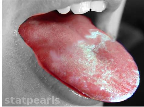 Figure Oral Leukoplakia Image Courtesy O Chaigasame Statpearls