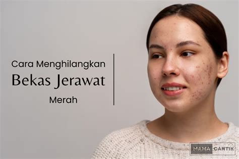 Cara Hilangkan Bekas Jerawat Merah Di Pipi