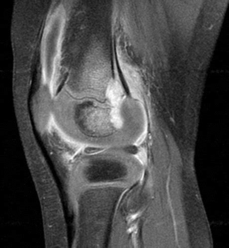 Hematogenous Osteomyelitis In Infants And Children Imaging Of A