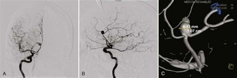 Microsurgery Of Distal Anterior Cerebral Artery Aneurysms Clinical Gate