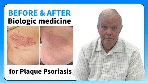 Life Changing Relief For Our Patient With Plaque Psoriasis Using