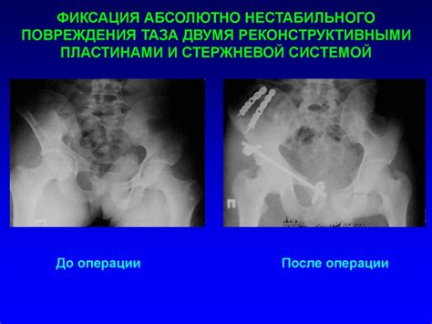 Переломы костей таза - презентация онлайн