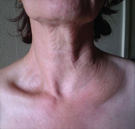 Lymphoma swollen neck and supraclavicular lymph nodes - publicgugl