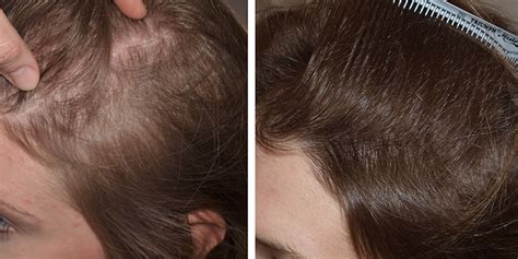 Best Hair Transplant Clinics In Dubai