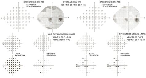 Visual Field Of The Right Eye On The Left Side Before Treatment And The