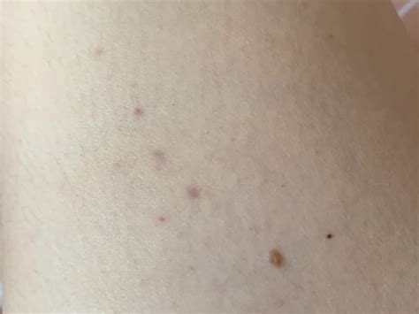 Woke up with these three purple dots on my leg? Any ideas why? : r/skin