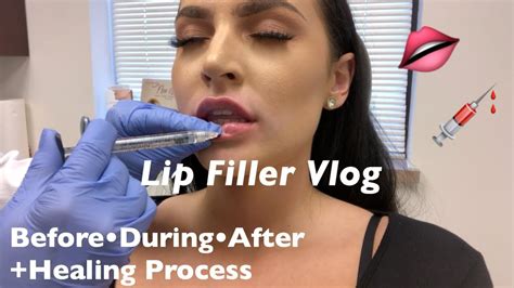 Lip Filler Vlog My First Time Getting Lip Filler Juvederm Ultra