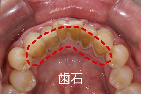 そもそも歯石ってなに？｜姫路駅前グランツ歯科｜姫路市の歯科・口腔外科・矯正歯科｜姫路駅前グランツ歯科｜姫路市の歯科・口腔外科・矯正歯科