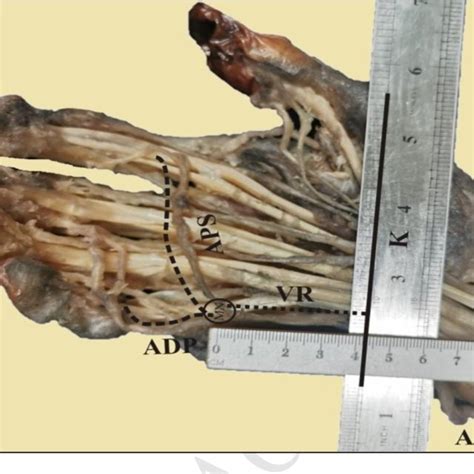 Pdf Anatomical Variations Of The Superficial Palmar Arch And Its