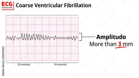 Coarse Ventricular Fibrillation Ecg