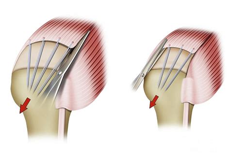 Rotator Cuff Shoulder Surgery Photograph by Maurizio De Angelis/science ...