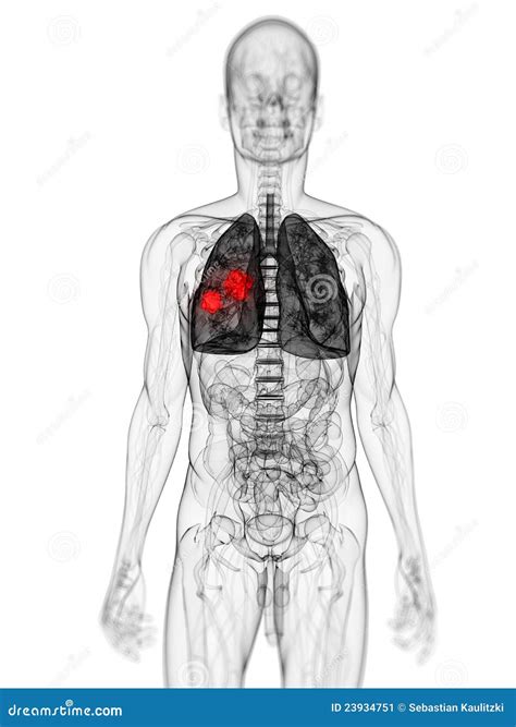 Lung Tumor Stock Illustration Illustration Of Science 23934751