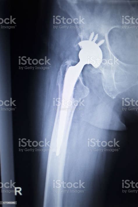 Xray Scan Image Of Hip Joint Replacement Orthopedic Implant Stock Photo