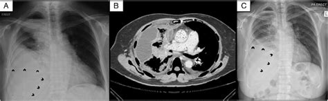 Chest Radiograph A Showed A Loculated Right Pleural Effusion With