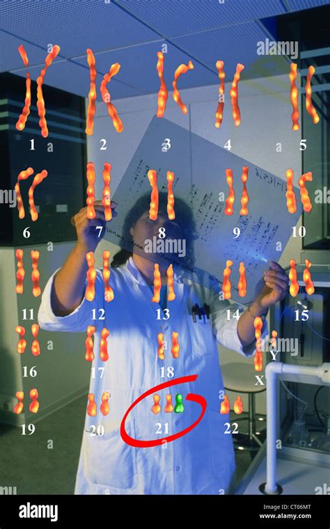 DOWN'S SYNDROME KARYOTYPE Stock Photo - Alamy