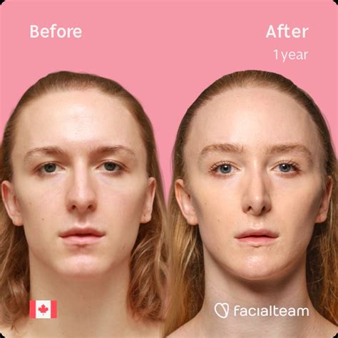 Amelia Before And After Ffs Surgery Facialteam