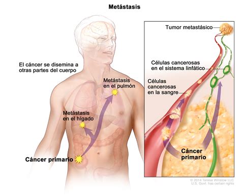 Definición de metastásico Diccionario de cáncer del NCI NCI