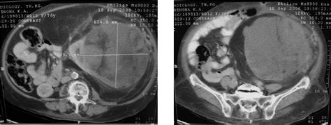 Figure From A Case Of Giant Isolated Renal Angiomyolipoma In An