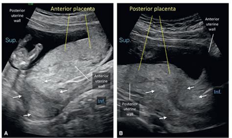 Placenta And Umbilical Cord Radiology Key