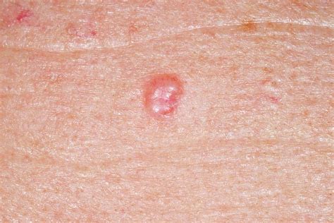 What Does Skin Cancer Look Like Photos Basal Cell Carcinoma Hot Sex