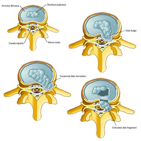 Lumbar Disc Herniation Dr Russell D Caram Chiropractic Physician